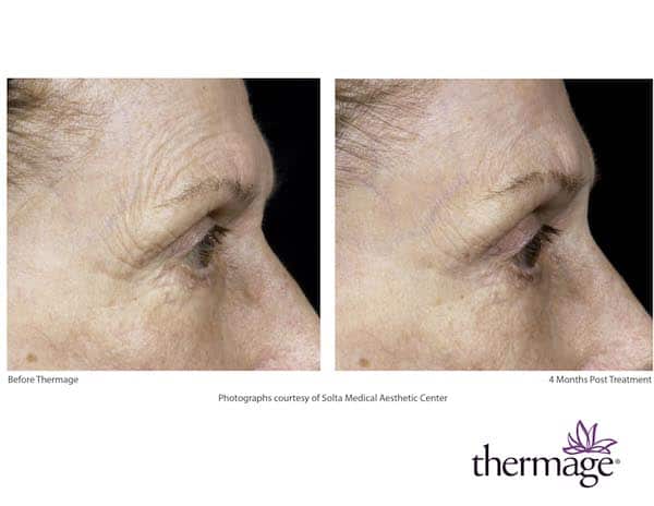 thermage_before_after_eye
