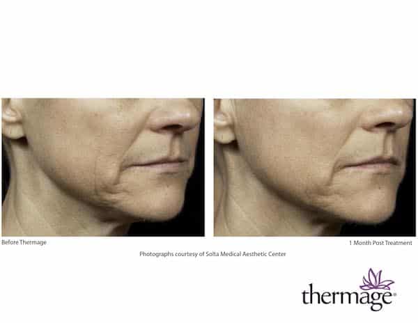 thermage_before_after_mouth