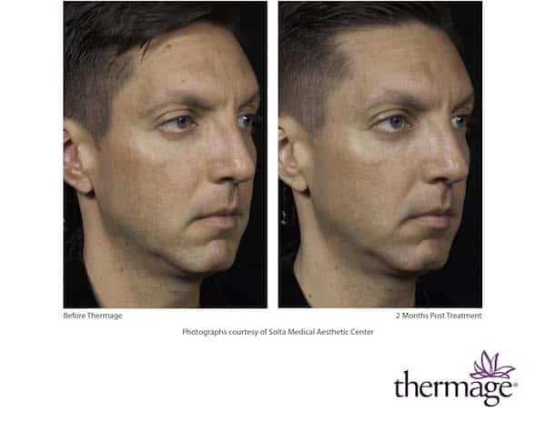 thermage_before_after_face