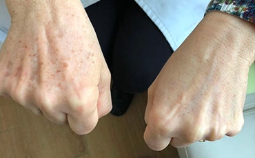 cryopen_cryotherapy_before_after1