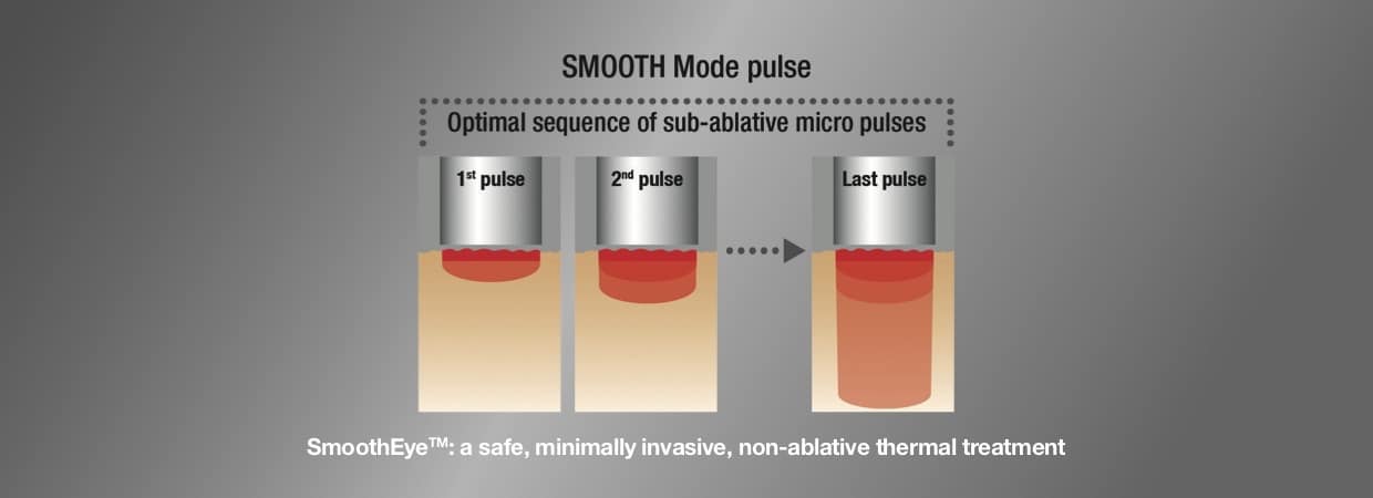 how fotona smootheye works
