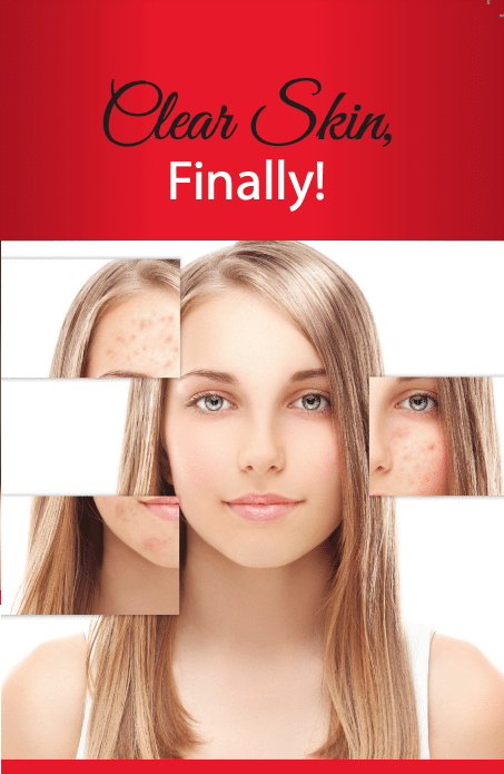 fotona-acne-treament-brochure