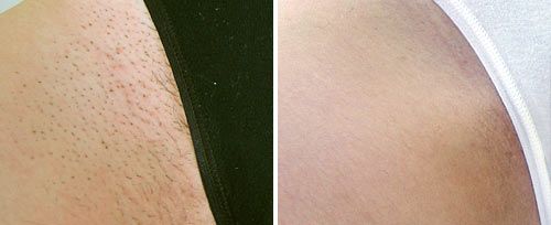 fotona laser hair removal before and after - bikini