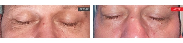 fotona smooth eye before and after - 1