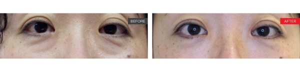 fotona smooth eye before and after - 2