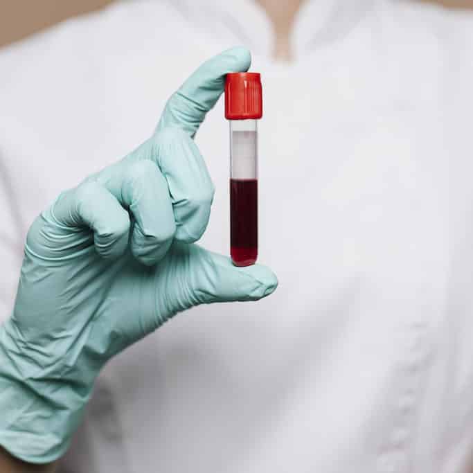 nurse-holding-blood-test-tube-prp