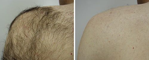 fotona laser hair removal before and after _ shoulder